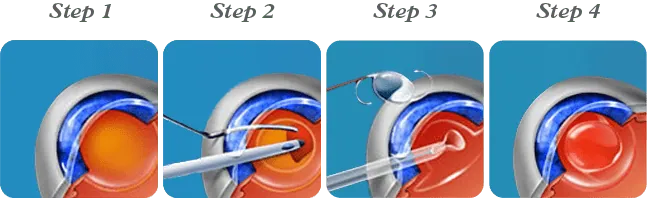 Implant în scop refractiv