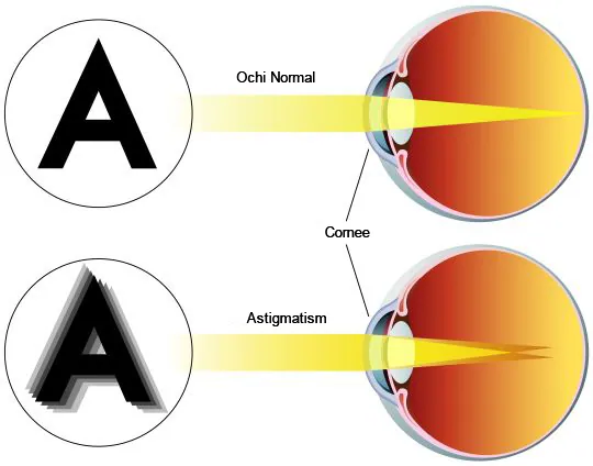 Cauza vederii neclare din astigmatism