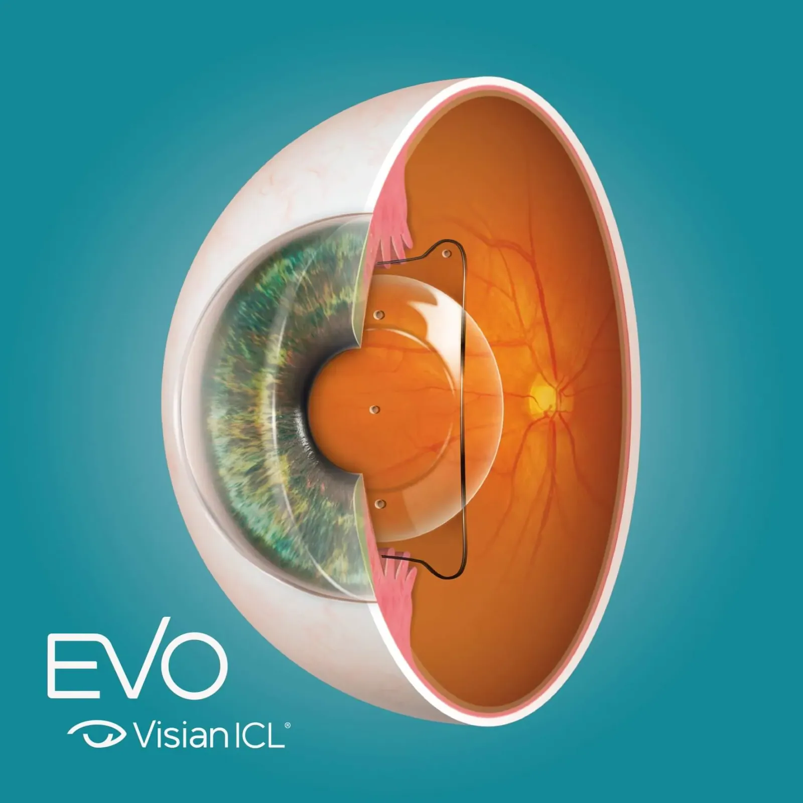 EVO Visian ICL