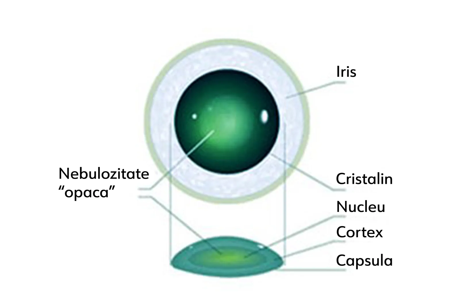 Cataracta nucleară — opacifierea nucleului cristalinului