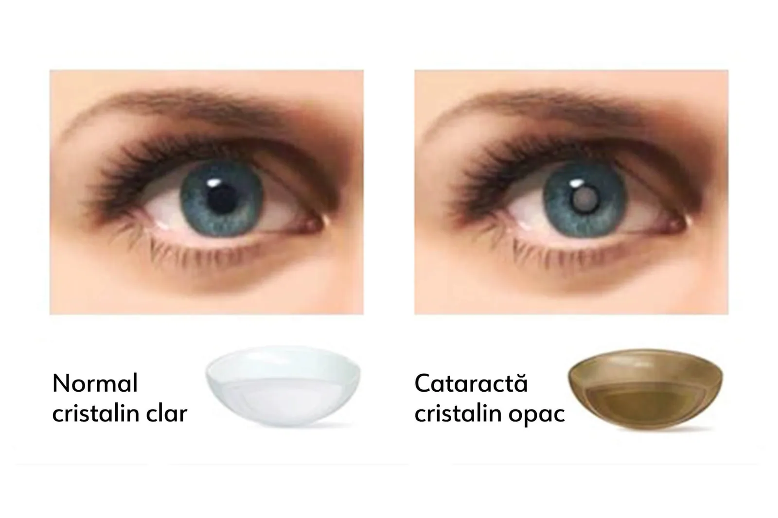 Ce este cataracta — ochi cu cristalin opacifiat