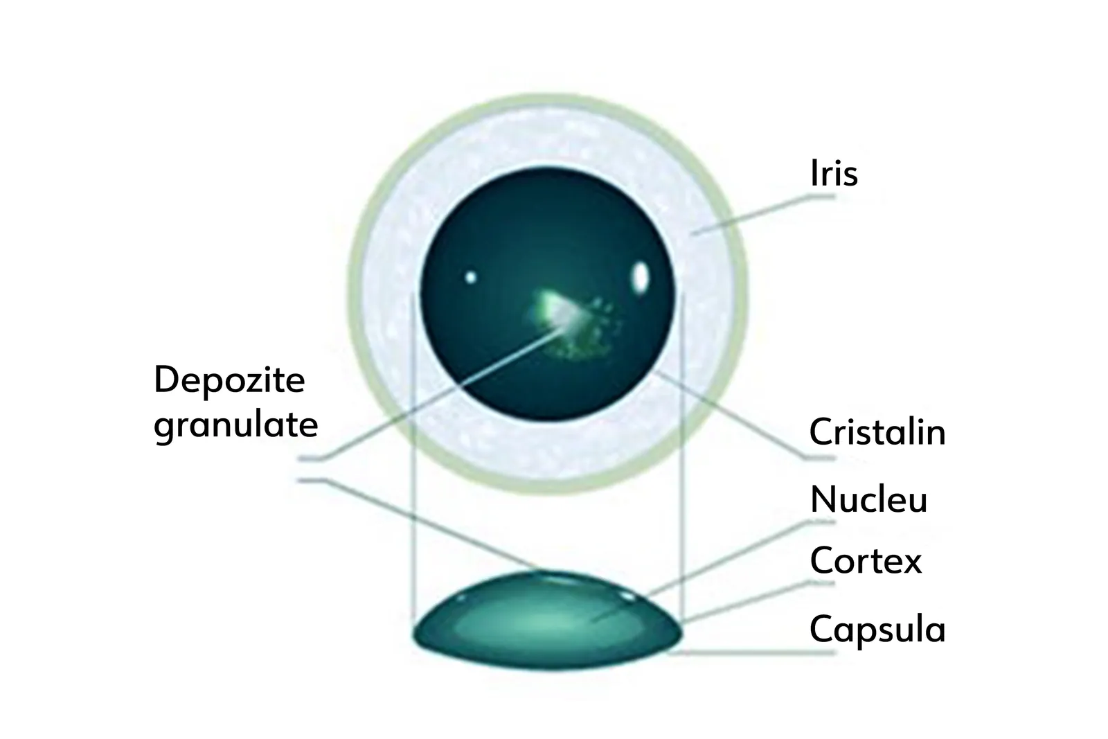Cataracta subcapsulară posterioară — opacifiere între cristalin și capsula posterioară