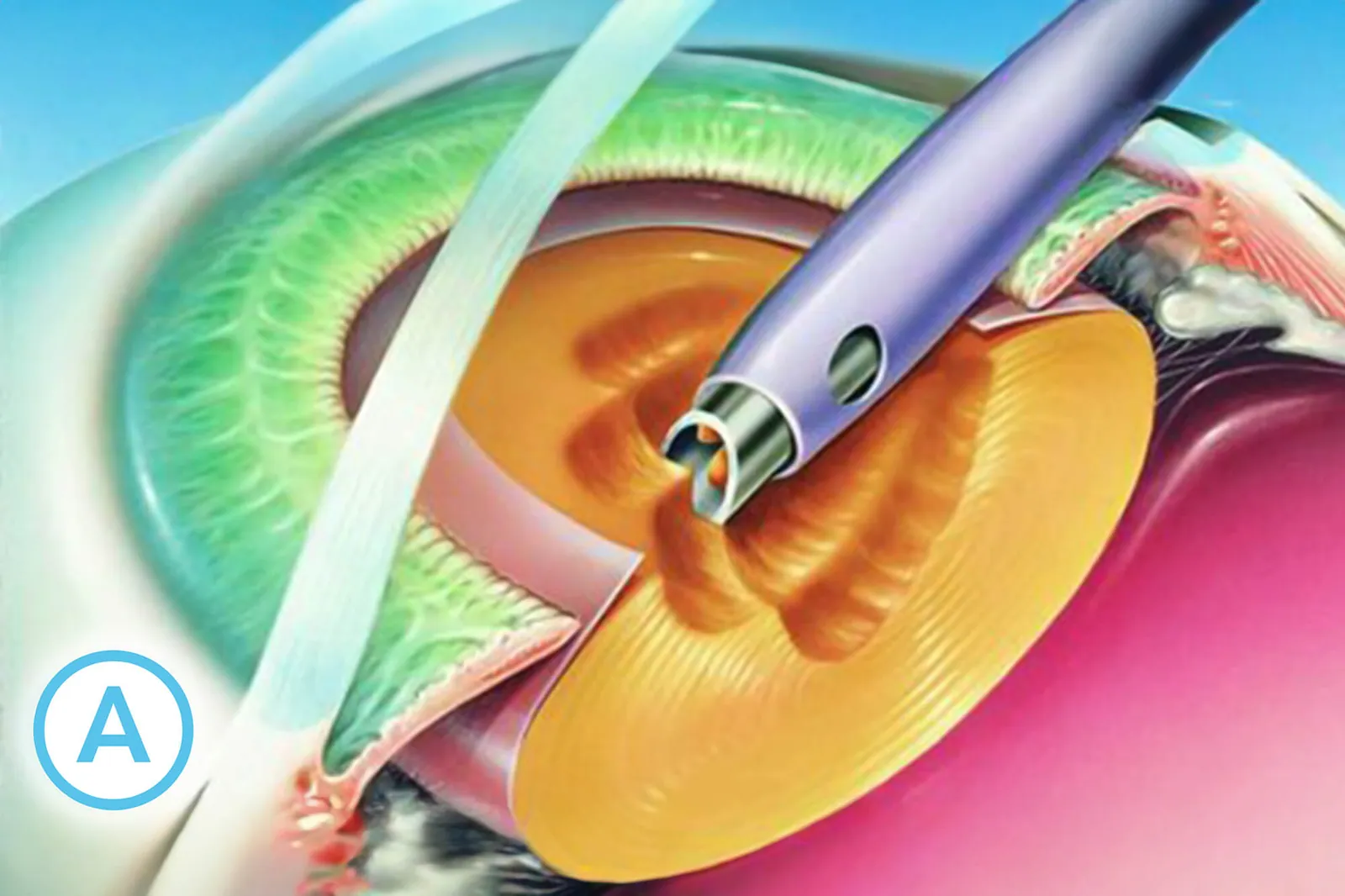 Ilustrație medicală: facoemulsificarea cristalinului opacifiat cu ultrasunete