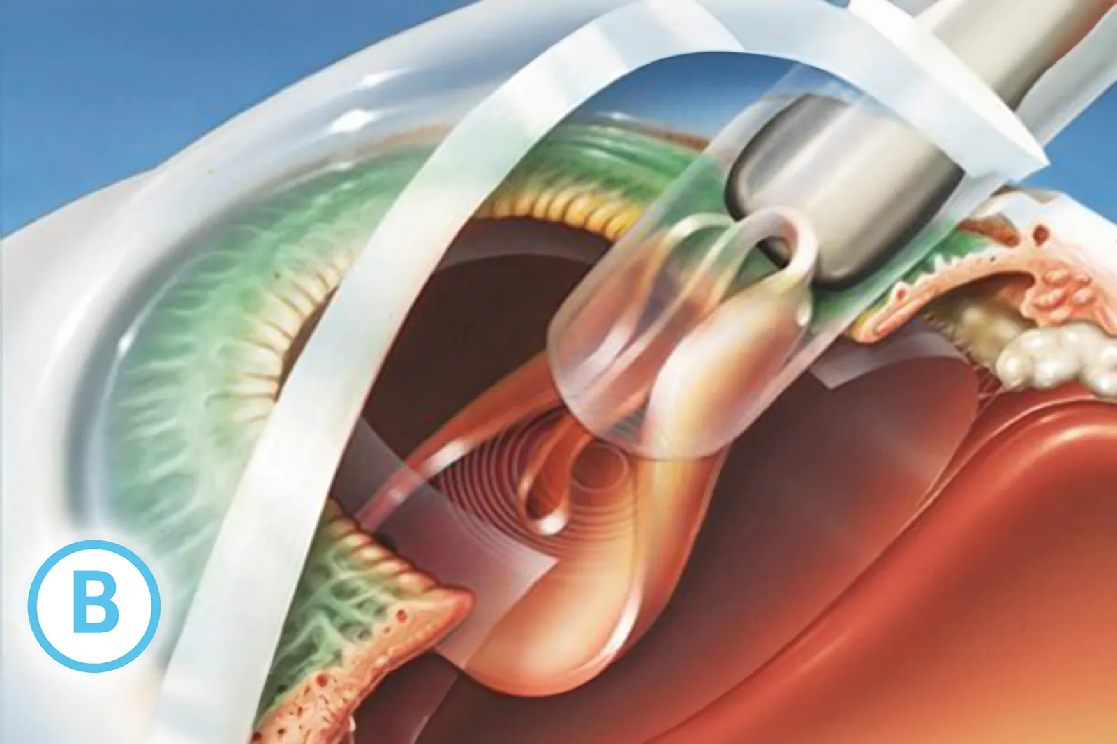 Ilustrație medicală: injectarea cristalinului artificial foldabil în sacul cristalinian