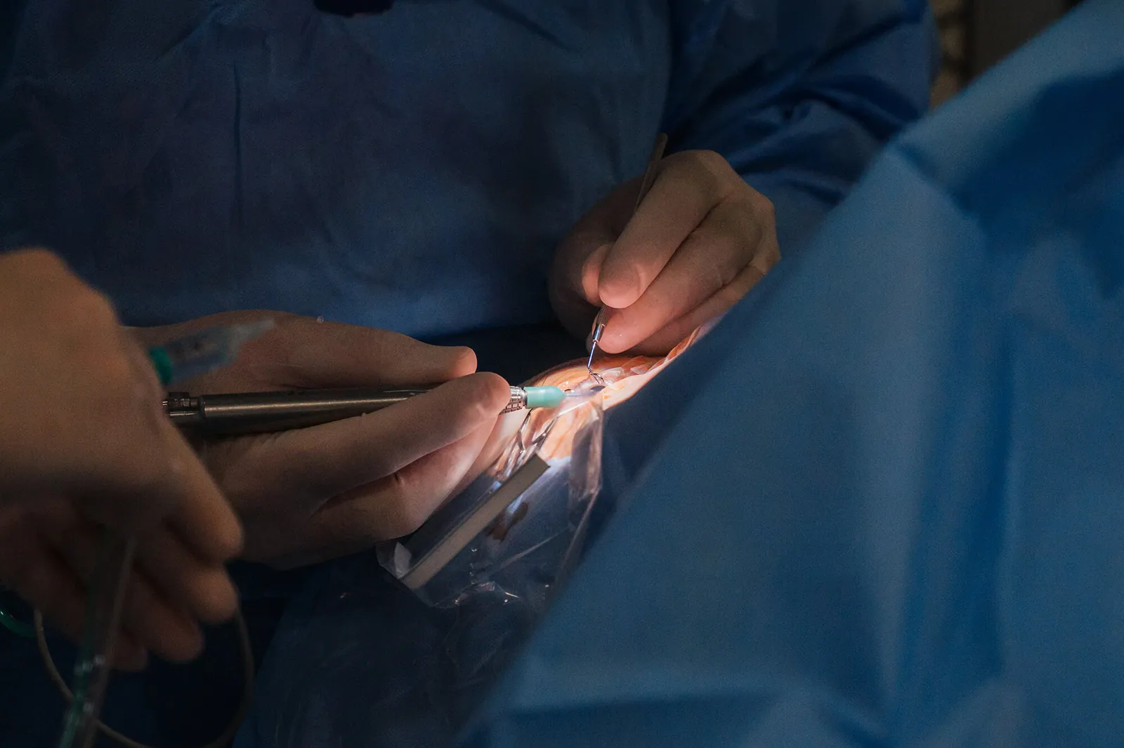 Chirurg oftalmolog Ama Optimex în timpul unei operații de cataractă
