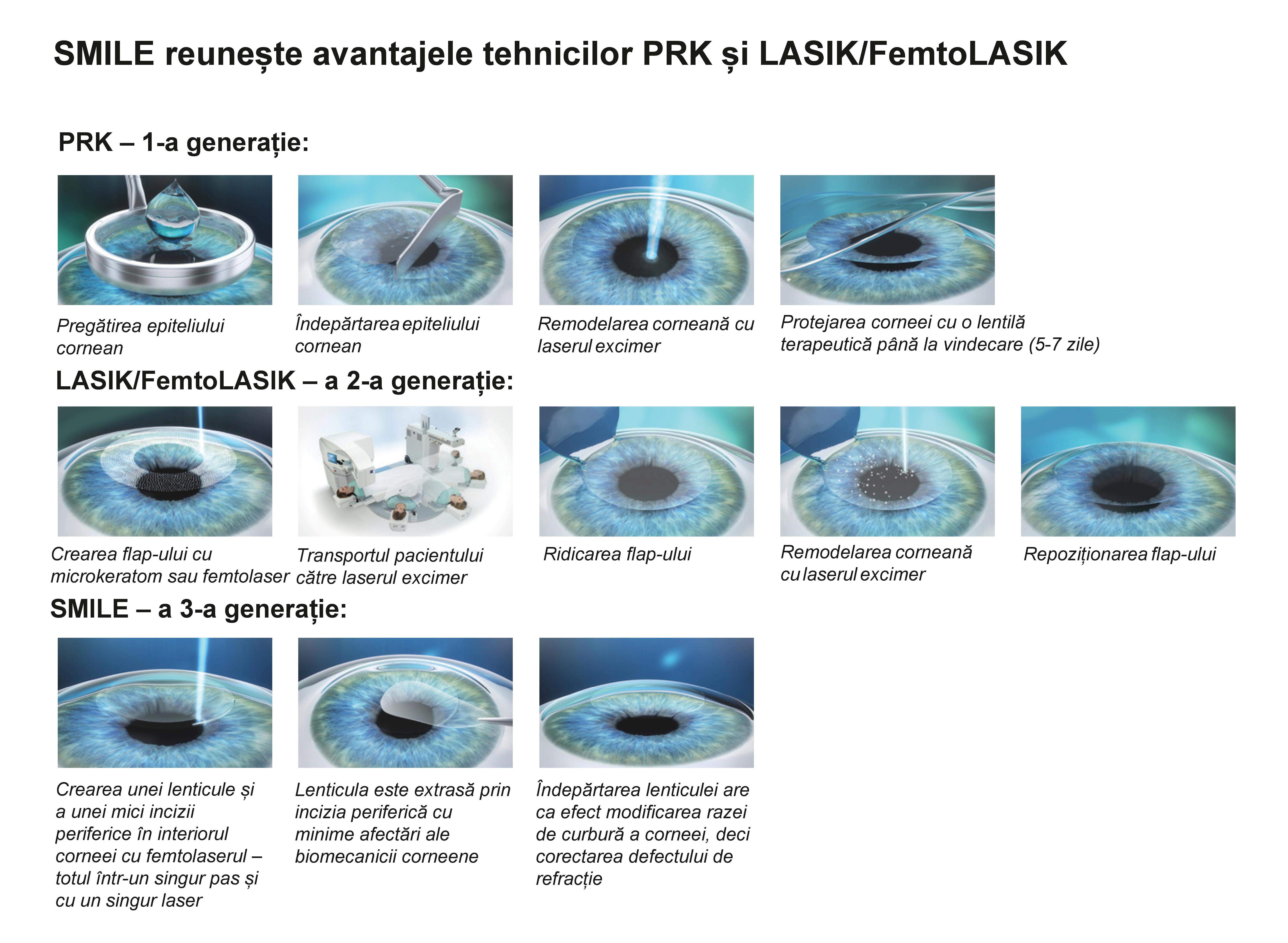 3-generatii-chirurgie-refractiva