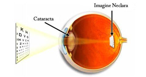 Cataracta