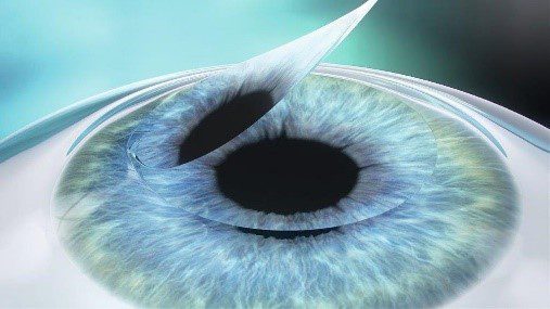 Presbyond Operatie Laser Corectie Presbiopie, 4, amaoptimex.ro