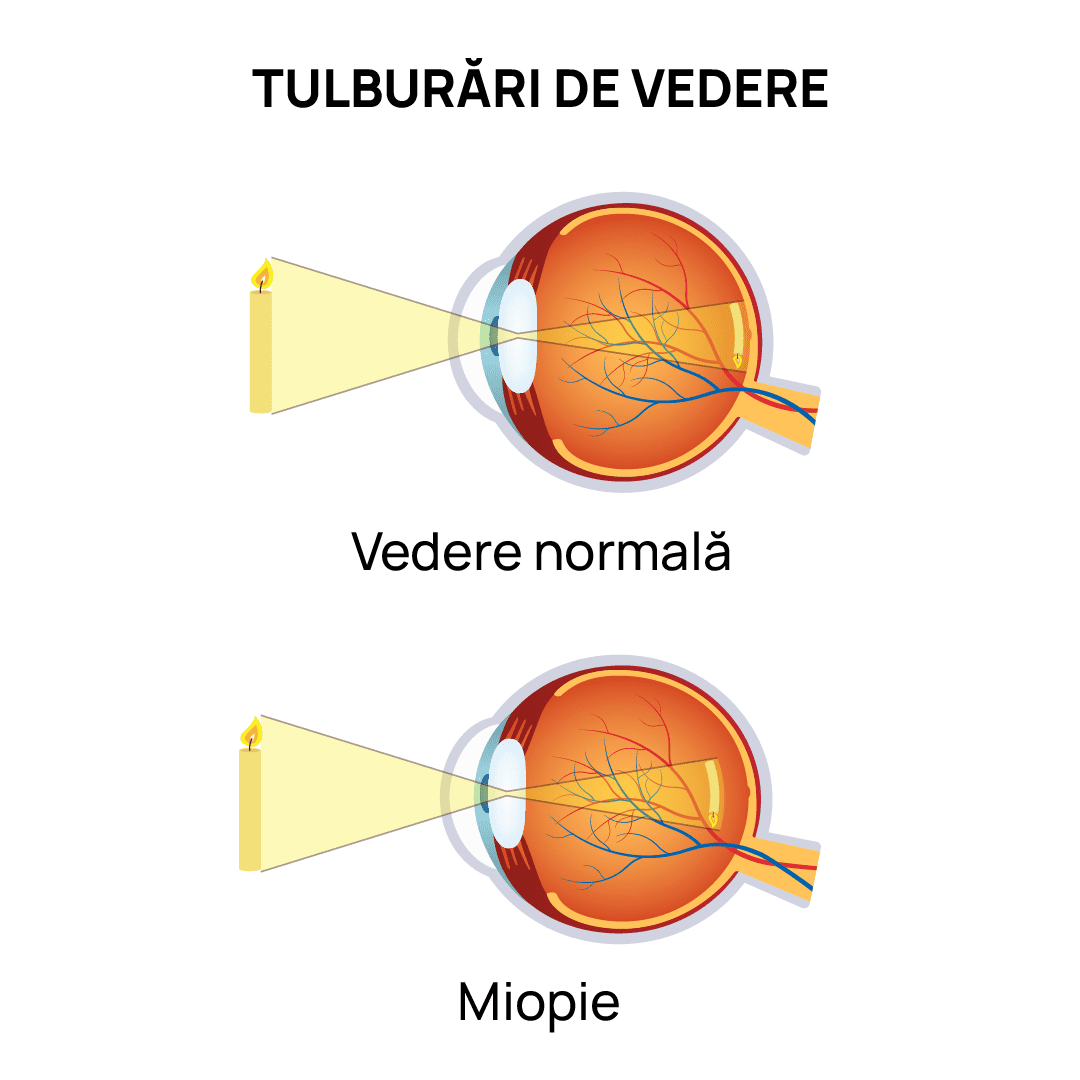 Simptome miopie