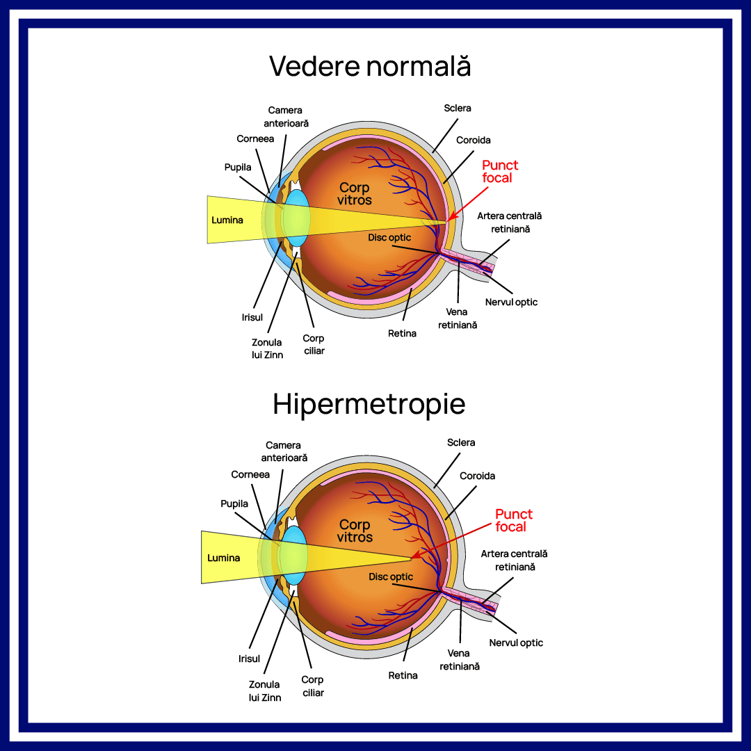Hipermetropia