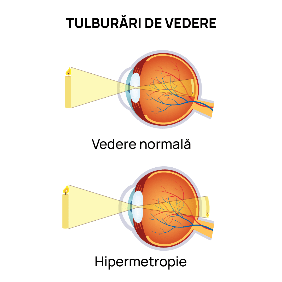 Simptome Hipermetropie